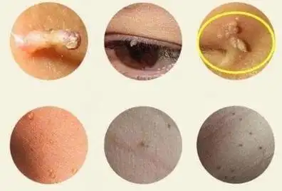 1女人感染hpⅴ有啥症状图片