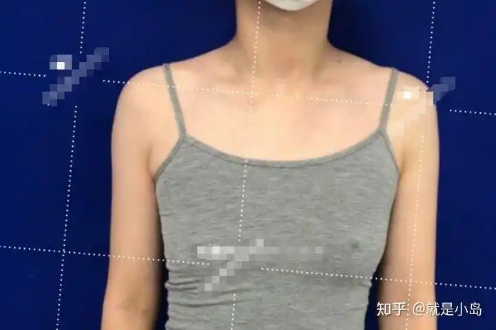 南京假体隆胸哪里好?对比案例看看曼托 水滴形假体 255cc效果