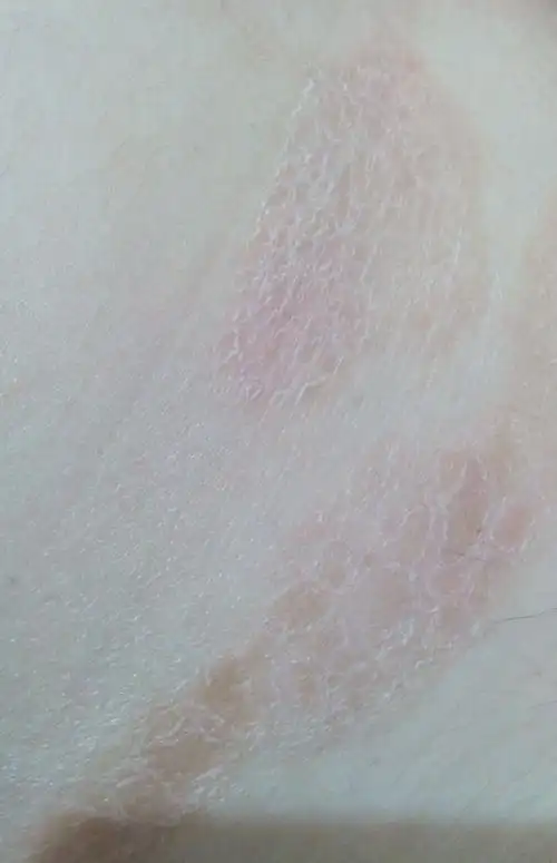 皮肤上这一片颜色有点粉,起皮,偶尔很痒,起了两年了,请问这到底是怎么