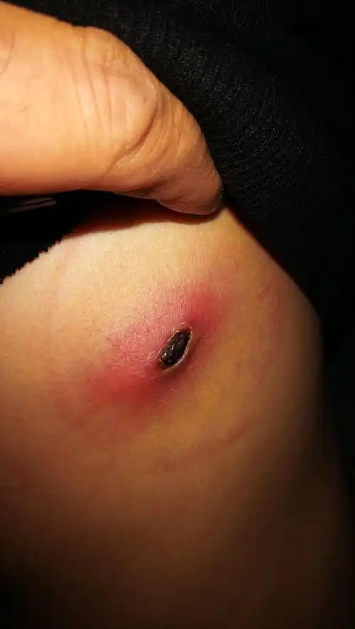 皮肤溃烂图片求分析诊断