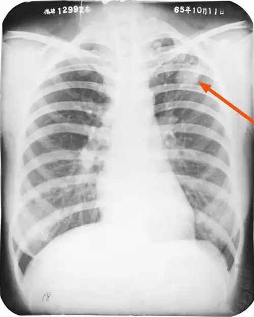 胸片如何看肺炎这篇文章帮你立刻入门