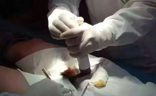 无为县人民医院包皮环切新术式包皮过长