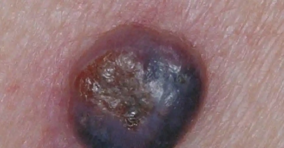 北京皮肤癌专家_北京治疗皮肤癌哪个专家好_北京治疗皮肤癌最好的专家