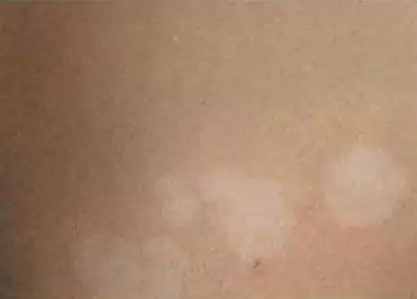 皮肤科医生,教你通过皮损颜色,辨色治疗白癜风!_白斑