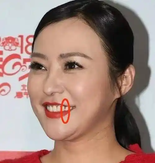 郝蕾的蛀牙殷桃的痣打了多少滤镜女明星的脸