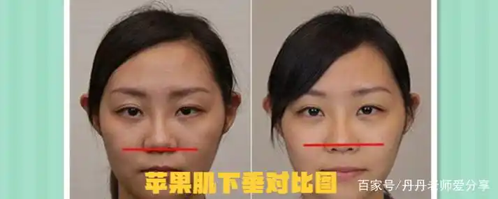 苹果肌对比照 苹果肌照片对比