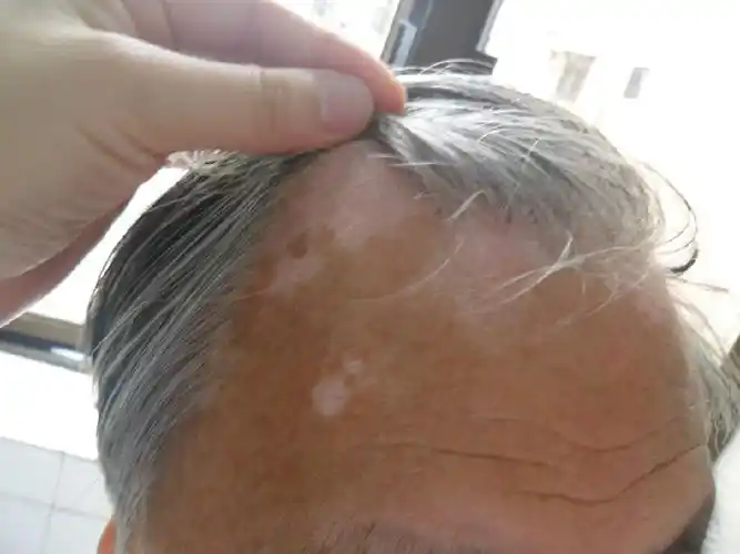 白斑是白癜风吗