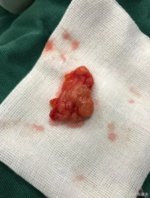 "工作即修行"----乳腺纤维腺瘤手术_乳腺纤维瘤_乳腺纤维瘤治疗方式