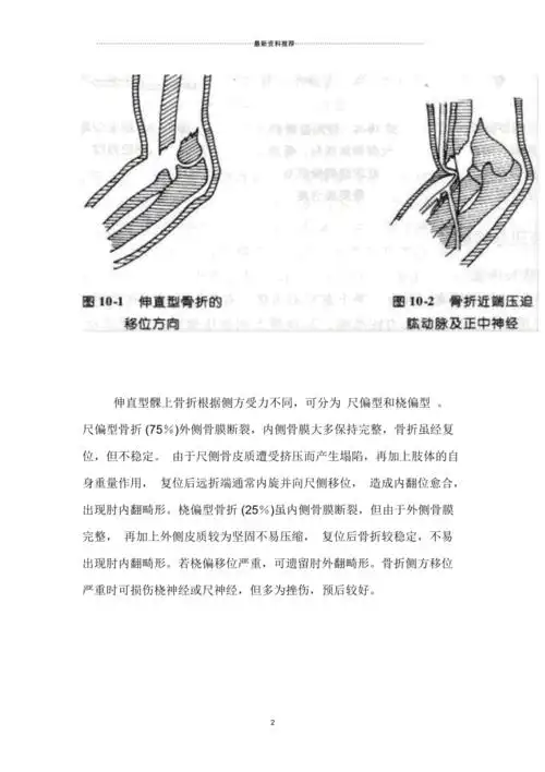 肱骨髁上骨折分型