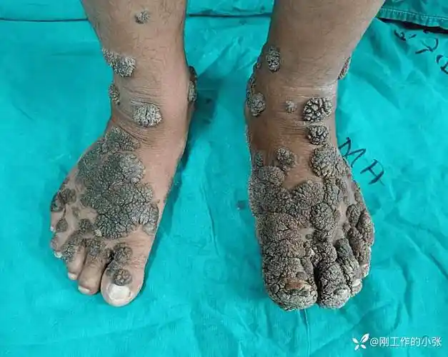 足背侧和左足底侧多处离散或聚结的色素沉着过度,角化过度和菜花状