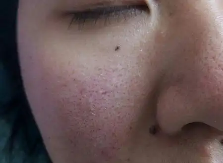 十八岁女生 鼻子和鼻子两侧毛孔粗大 脸上还有张黑头一样的东西 挤