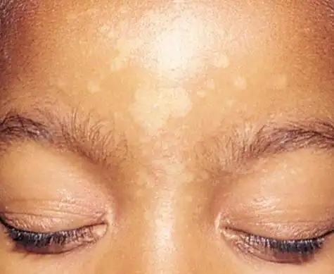 汗斑图片大全50