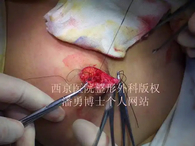 乳头内陷矫正手术全过程 - 好大夫在线