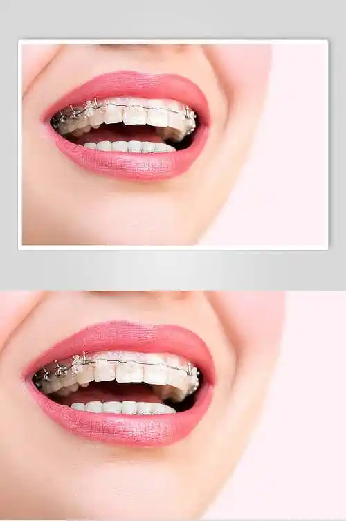 口腔健康牙套牙齿矫正图片