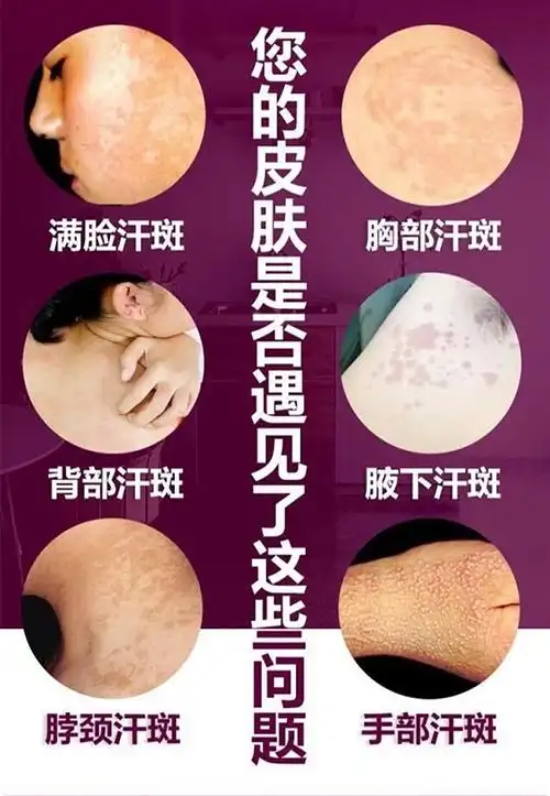 【买1送1】宛中 白鲜皮抑菌液(汗斑净) 20ml 汗斑喷剂后背褐斑脱皮