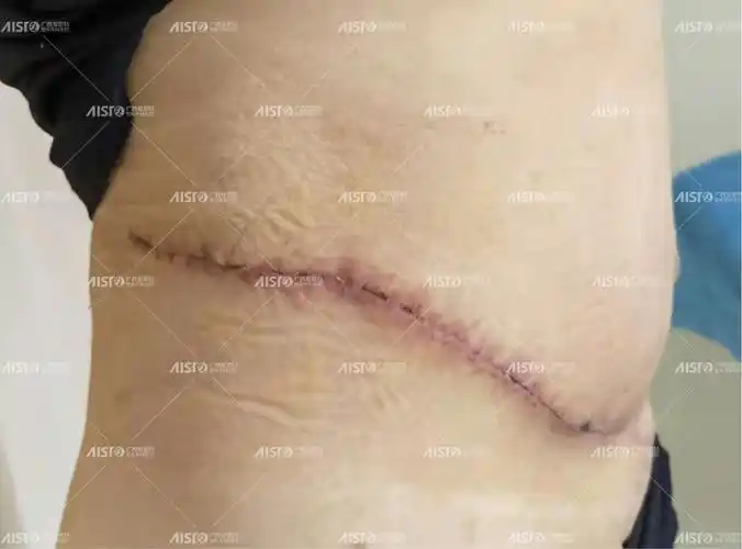 35 二胎老师做腹壁整形手术连续切除几斤皮,重现小蛮腰 - 新闻频道
