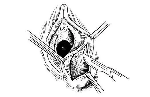 女人那个地方长疙瘩是怎么回事?感染的可能性大吗?_网易订阅