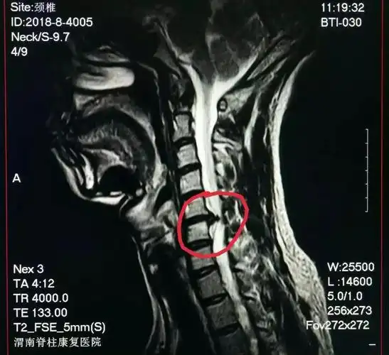 "一根针"治疗巨大颈椎间盘突出,让患者免受开刀之苦