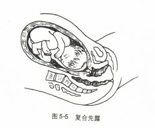 【分娩方式】仅胎手露于胎头旁,或胎足露于胎臀旁者,多能顺利经阴道