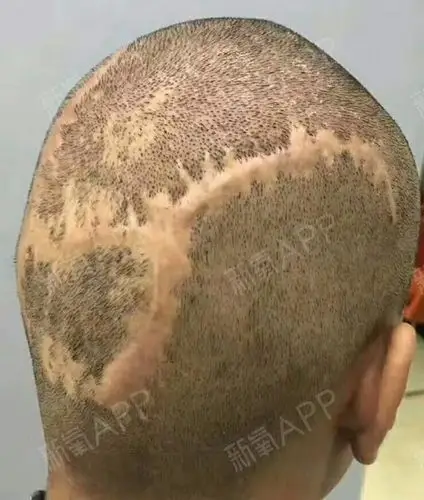 一次意外,做了开颅手术,加上缝合留下个挺大的疤痕,_圈子-新氧美容