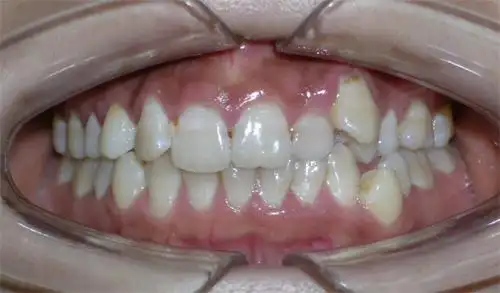 牙齿不整齐矫正病例(图)