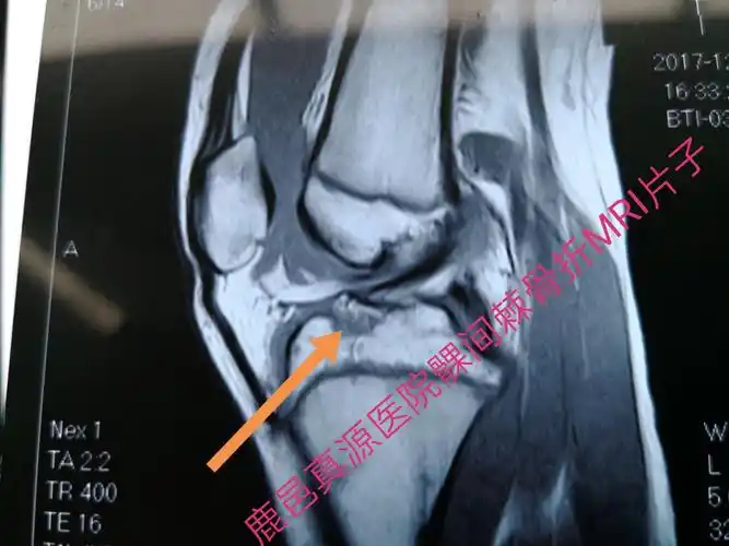 胫骨髁间棘骨折术前mri片子,显示髁间棘骨折!