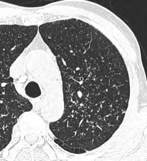 血行播散型肺结核轻松学习胸部影像