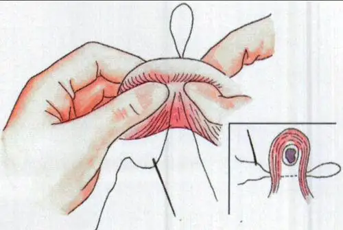 结扎对女人有什么伤害 女人结扎了还能生吗?_手术