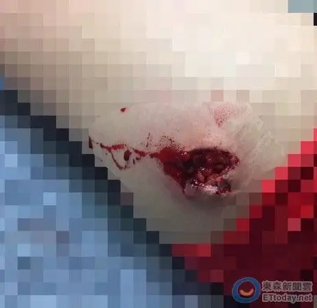 慎入!吴心缇摔破大腿肉绽 伤口有50元硬币那麼大