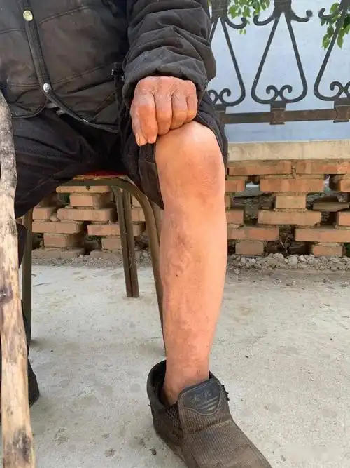 杨金榜腿部战争时期受伤留下的伤疤杨金榜手上战争时期受伤留下的疤痕