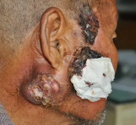 虽然皮肤癌实际上很多,结果有些是不好的,但是如果早期发现就可以达到