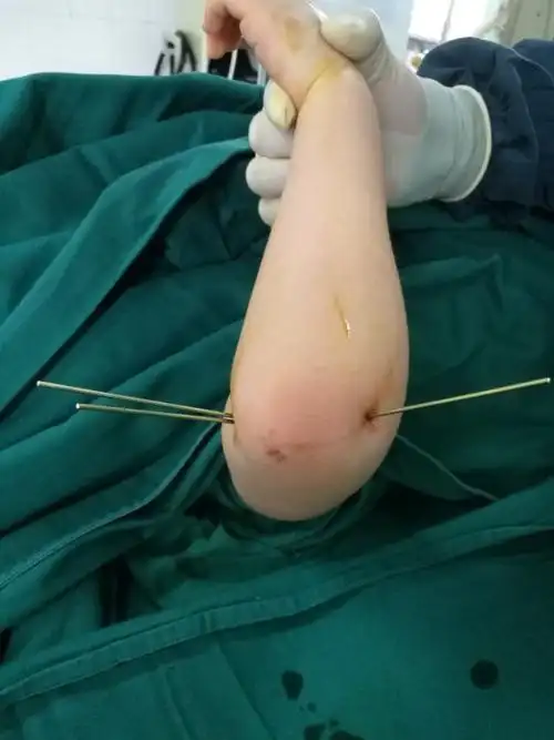 肘部经皮克氏针固定特写