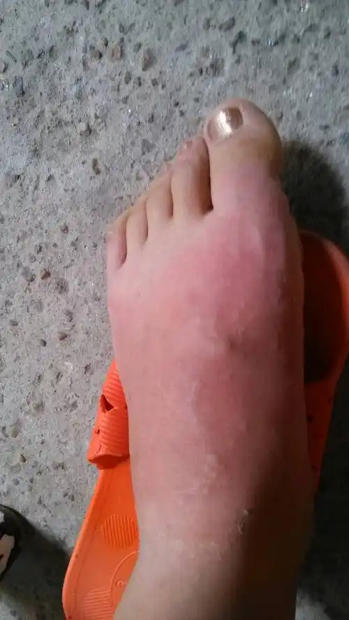 我的脚背每年夏天就奇痒,全抓破了,治脚气和治藓的药都用也好不了