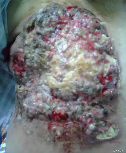 一例双侧原发性乳腺癌,左侧胸壁复发(进行性更新) [病例帖]