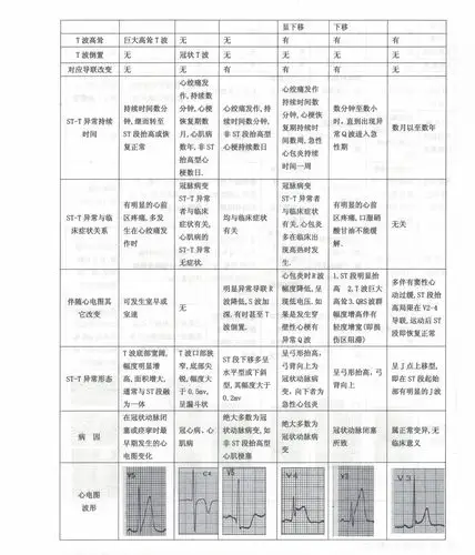心电图的鉴别诊断图片解读