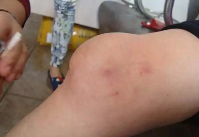 膝盖又疼又肿1捧黄豆大蒜疼痛消失不见滑膜炎也离你而去