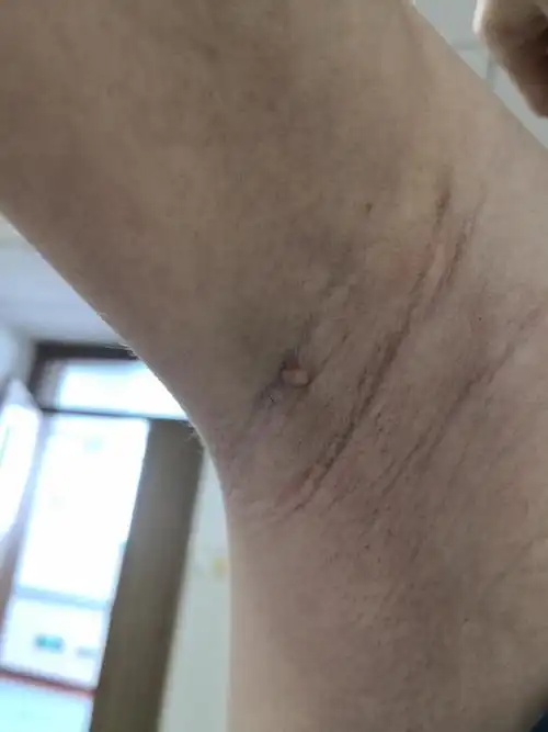 腋下皮下肿物,考虑皮脂腺囊肿症状.可以手术切除治疗.