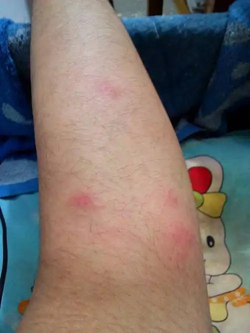 小腿上这么多红色的疙瘩,痒痒的.骑车子回来就是这样了.怎么回事?