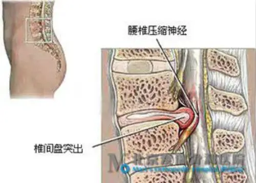 腰椎间盘突出保险报销吗 腰间盘突出保险报销
