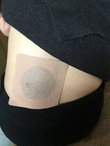 急性腰扭伤,摔伤,贴敷痛点