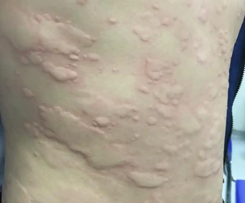 一般来看,这很可能是:荨麻疹;  大部分是由于饮食过敏导致的;  儿童