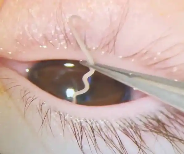 妈妈吓得惊叫,医生:和宠物有关_虫子_盛女士_结膜