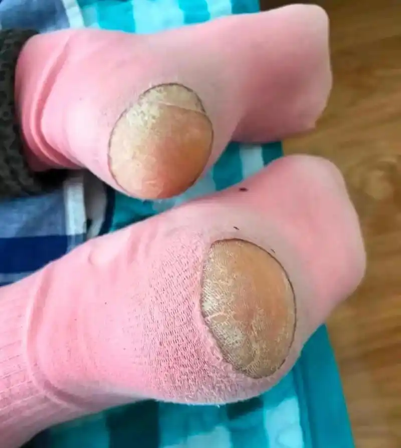 袜子脚后跟老是破个洞,不知道是袜的问题还是脚的问题.