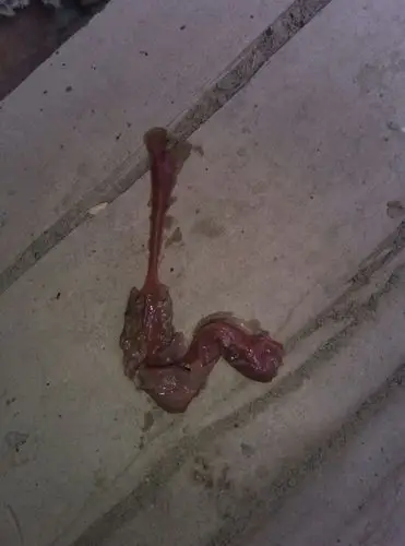 前两天去医院检查说是宫颈糜烂二度 霉菌性阴道炎 昨晚下了一块黑色肉