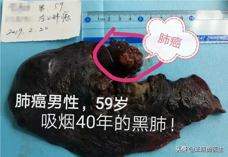 吸烟的人肺会变黑不吸烟的人怎么样医生告诉您真相