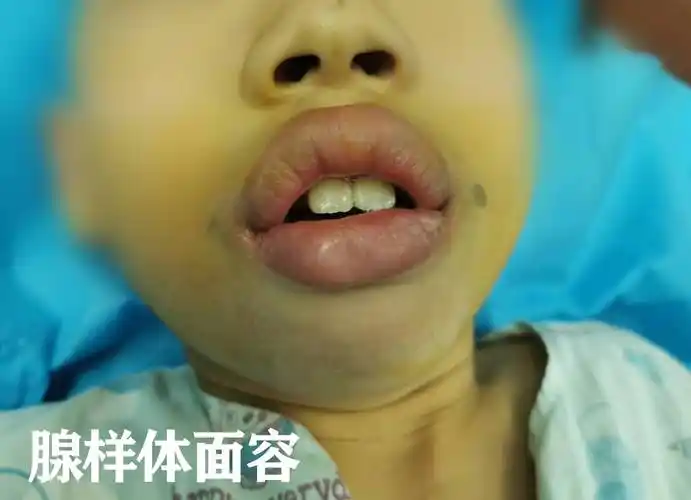 腺样体面容初期图片
