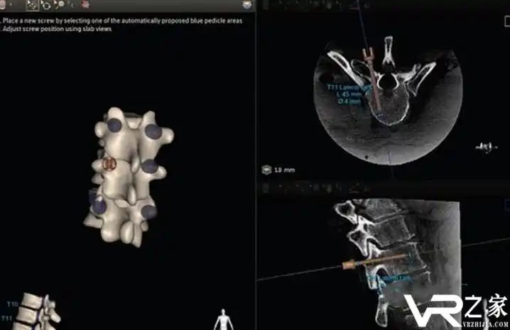采用微小切口或穿刺通道,运用特殊的器械和装置,在影像仪器监视下或