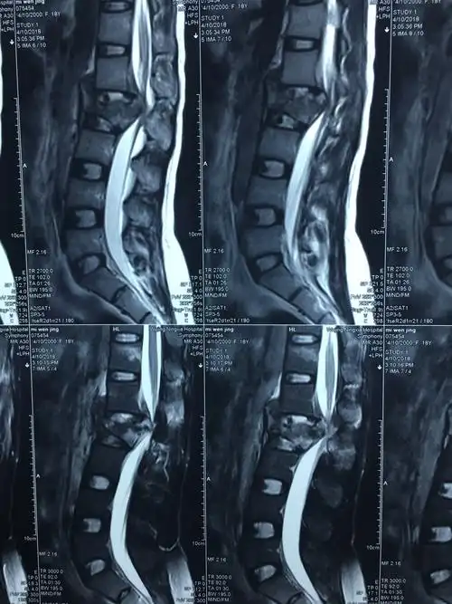 腰1椎体爆裂骨折_疗效
