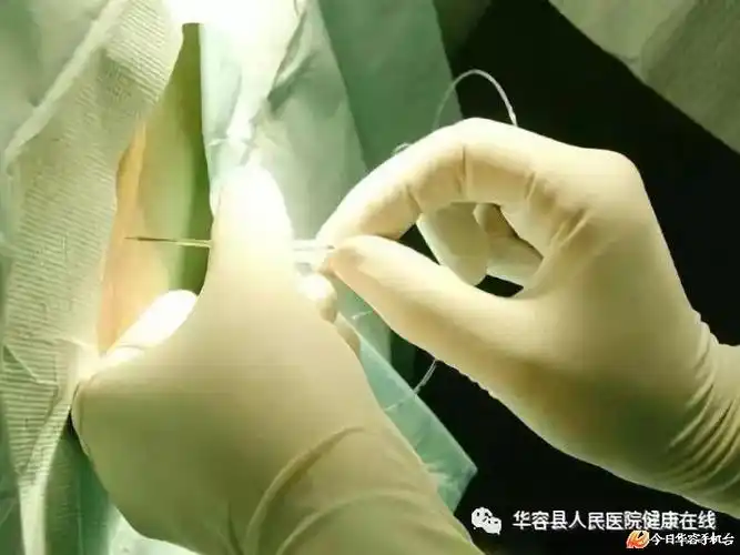 对240斤重的肥胖患者实施麻醉县人民医院的第一次很成功