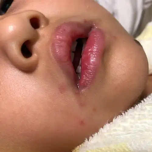 医生您好我女儿四岁1月23日发现舌系带附近有一个红泡小